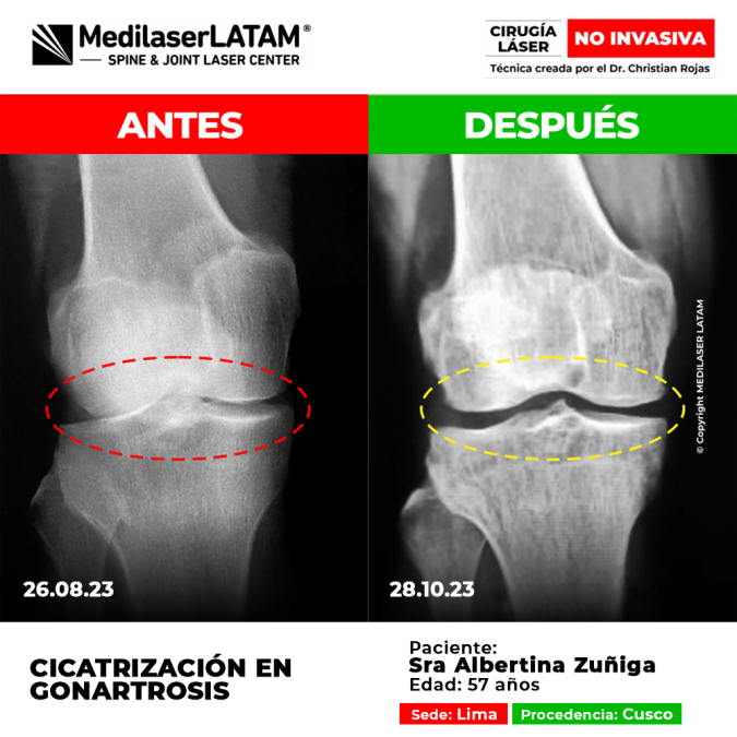 Evidencia en Cicatrización de Gonartrosis Comparativo radiológico que demuestra reparación cartilaginosa en artrosis de rodilla.