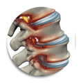 enfermadades-de-columna-medilaser-latam Tratamiento láser para hernias discales y dolor lumbar. Sin incisiones, sin riesgos quirúrgicos. Alta el mismo día y recuperación acelerada.