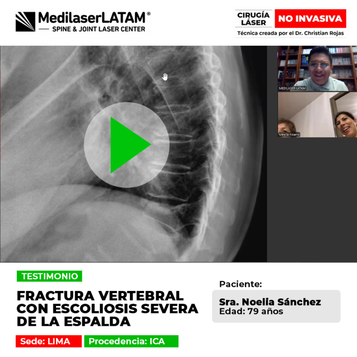 Testimonio: Fractura Escoliosis Vertebral severa en Noelia Sanchez (79). Vea cómo la cirugía láser mejoró su postura y frenó la desviación.