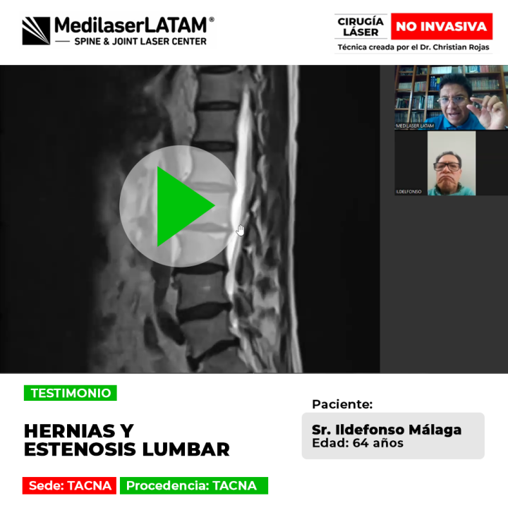 Hernias y Estenosis lumbar: Conoce el testimonio del Sr. Ildefonso Málaga que se operó con cirugía láser no invasiva en Medilaser LATAM