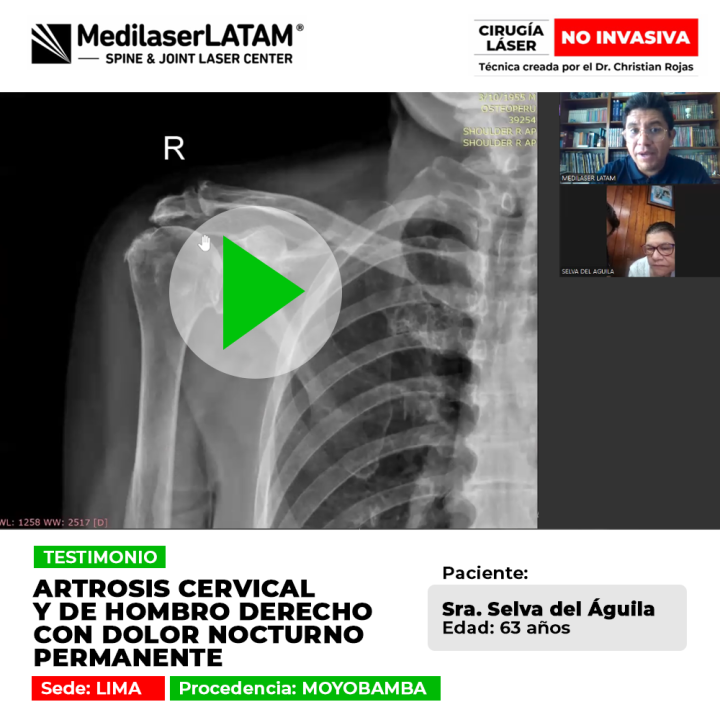 Artrosis cervical y de hombro derecho﻿: Testimonio de la Sra. Selva Del Águila sobre dolor nocturno en Medilaser LATAM.