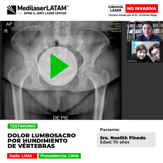 Testimonio de recuperación de dolor lumbosacro severo por Hundimiento de vértebras. Cirugía láser sin cortes para recuperar la movilidad.