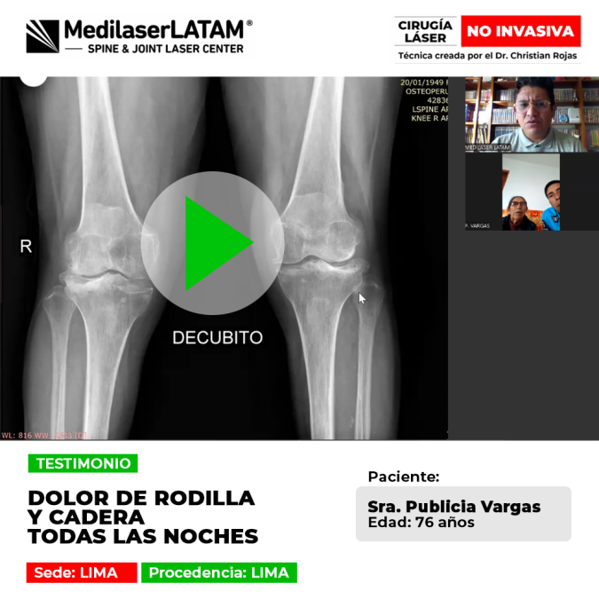 Paciente de 76 años logra superar el dolor nocturno de rodilla y cadera con tratamiento láser. Conoce cómo recuperar el descanso sin cirugías.