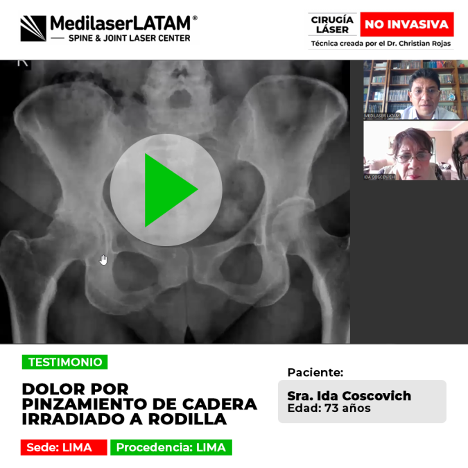 Testimonio sobre la recuperación de Pinzamiento de cadera y dolor irradiado a la rodilla. Descubre la eficacia del láser en casos crónicos.