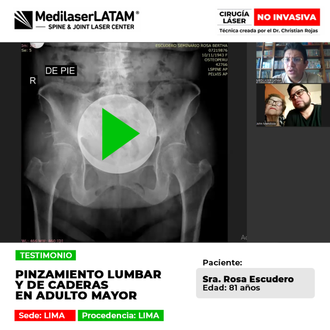 Paciente de 81 años recupera su movilidad tras tratar el Pinzamiento lumbar y de caderas. Solución avanzada para el dolor en adultos mayores.