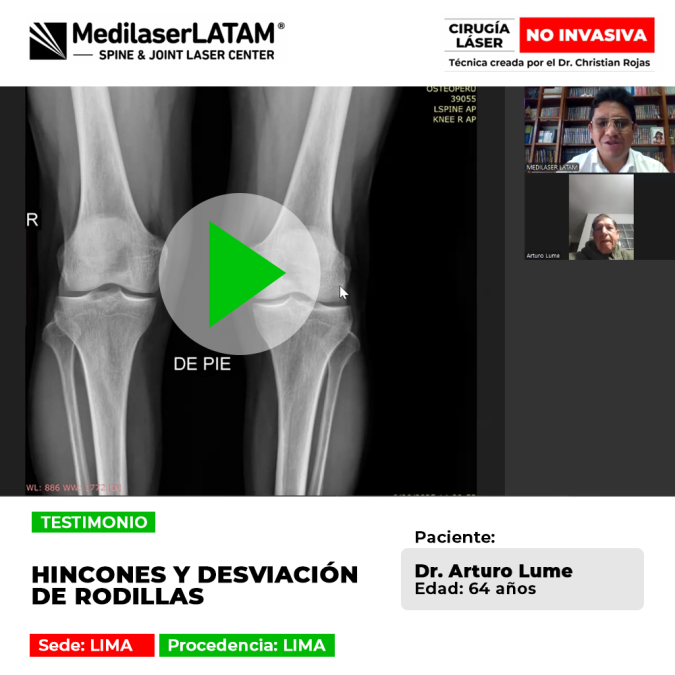 Paciente comparte cómo superó los punzantes hincones y la desviación de rodillas. Conoce este caso de éxito con tratamiento láser avanzado.