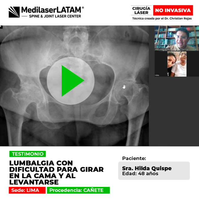 Recuperación de lumbalgia severa que impedía movimientos básicos en la cama. Conoce cómo recuperar la movilidad y descanso sin dolor lumbar.