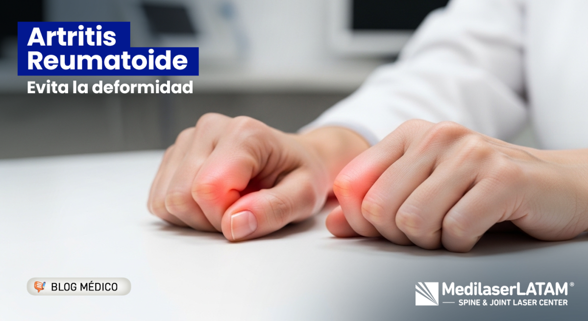 Artritis Reumatoide: conoce los síntomas tempranos y cómo proteger tus articulaciones antes de que el daño autoinmune sea permanente.