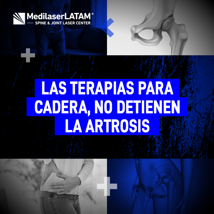 Artrosis de cadera: descubre por qué las terapias convencionales no frenan el desgaste y conoce la alternativa médica para detenerlo.