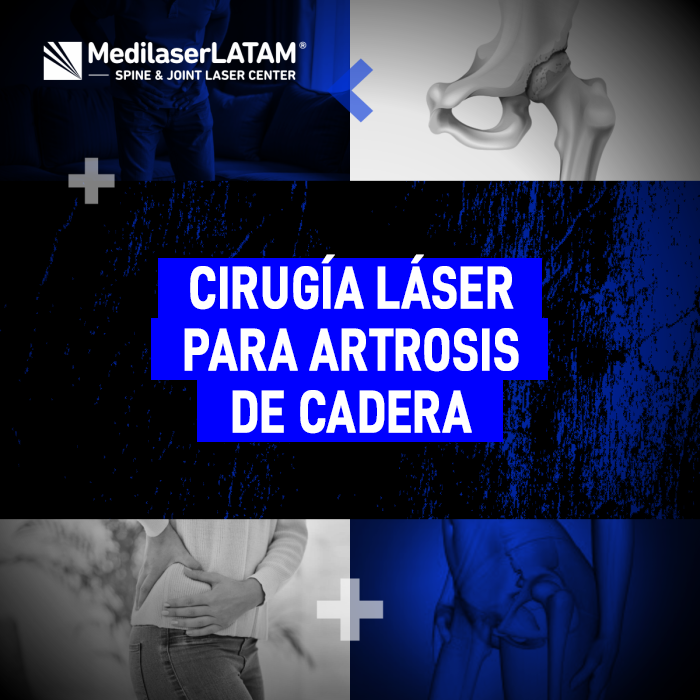 Cirugía láser para Artrosis de cadera: una alternativa avanzada y mínimamente invasiva para recuperar la movilidad sin usar prótesis.
