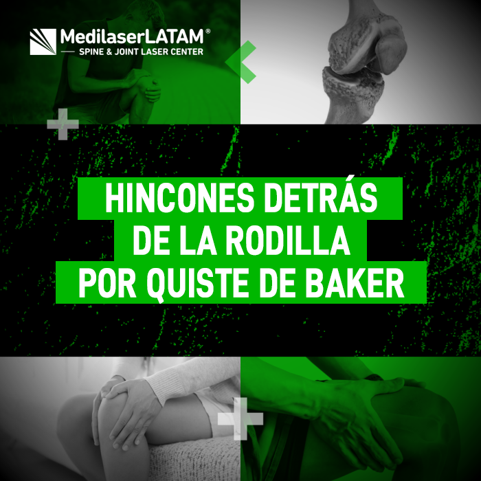 Quiste de Baker y los hincones detrás de la rodilla. Conoce más sobre esta afección y su tratamiento médico especializado en nuestro blog.