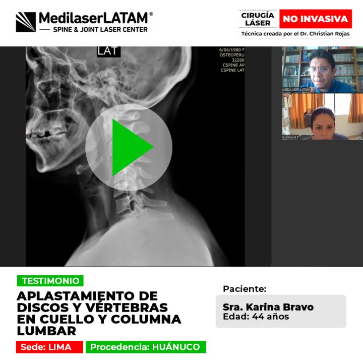 Aplastamiento de discos en cuello y columna lumbar: testimonio de recuperación efectiva sin cirugía para el dolor de vértebras crónico.