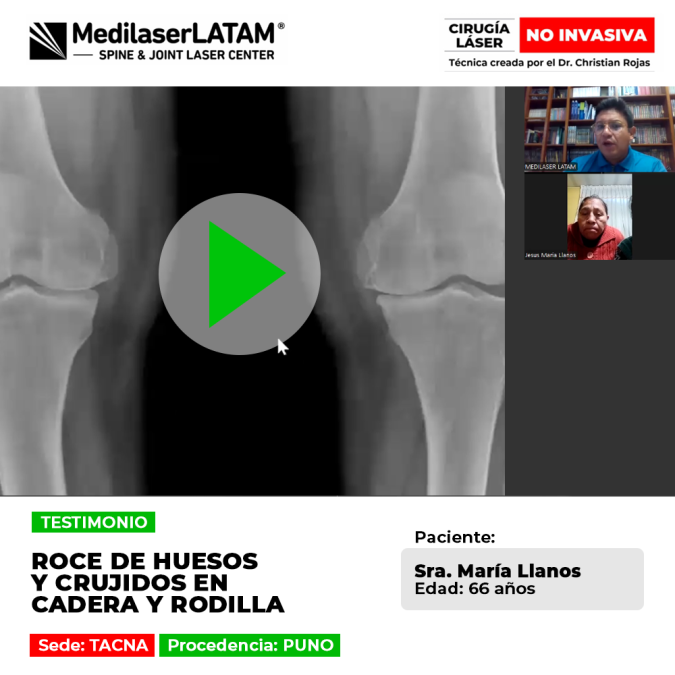 Roce de huesos y crujidos en cadera y rodilla: solución efectiva para el desgaste severo sin cirugías invasivas ni prótesis dolorosas.