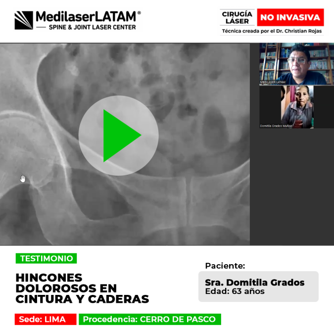 Hincones dolorosos en cintura y caderas: conoce el procedimiento láser que detiene el desgaste y elimina los pinchazos de forma ambulatoria.