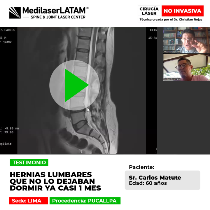 Hernias lumbares que no lo dejaban dormir. Mira cómo el tratamiento láser médico logra aliviar estas dolencias crónicas en Medilaser Latam.