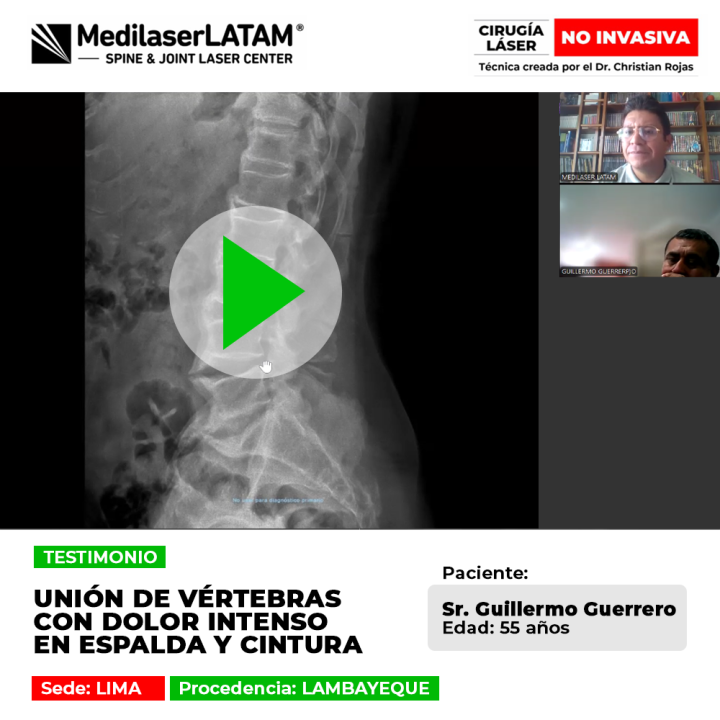 Unión de vértebras y dolor lumbar. ¿Es posible evitar la cirugía de columna? Descubre cómo el tratamiento láser médico logra este resultado.