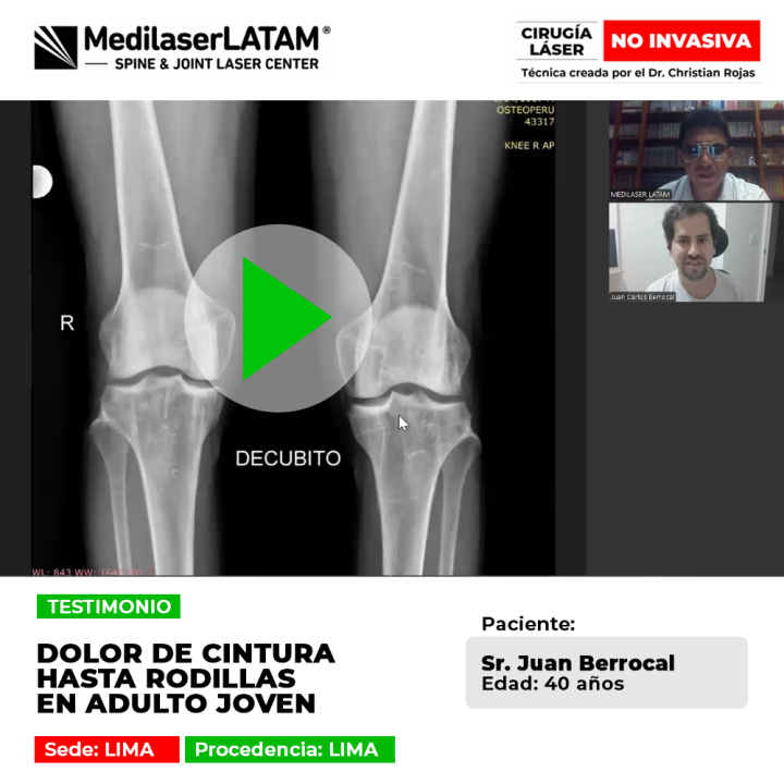 Conoce cómo un paciente joven logró superar el dolor lumbar irradiado a las piernas con tratamientos avanzados. Un testimonio real.