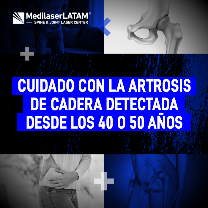 Infórmate sobre cómo abordar la artrosis de cadera a temprana edad y qué medidas tomar para frenar a tiempo el daño articular.