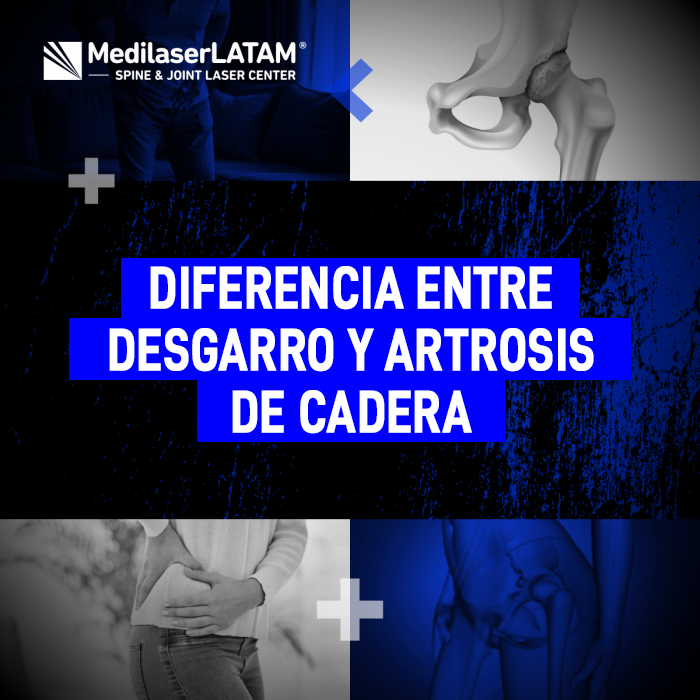La artrosis de cadera y un desgarro muscular comparten síntomas pero requieren manejos distintos. Conoce cómo diferenciarlos médicamente.