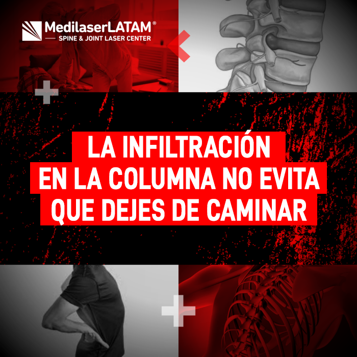Conoce la realidad sobre la infiltración en la columna y por qué este procedimiento no garantiza detener la pérdida de movilidad.