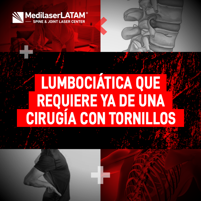 La lumbociática severa puede hacerte creer que la fijación con tornillos es tu única opción. Infórmate sobre esta condición aquí.
