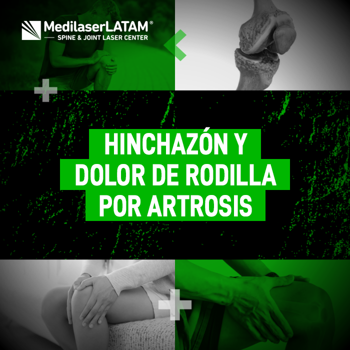 Descubre los tratamientos recomendados para combatir el dolor de rodilla y la inflamación articular provocados por el desgaste.