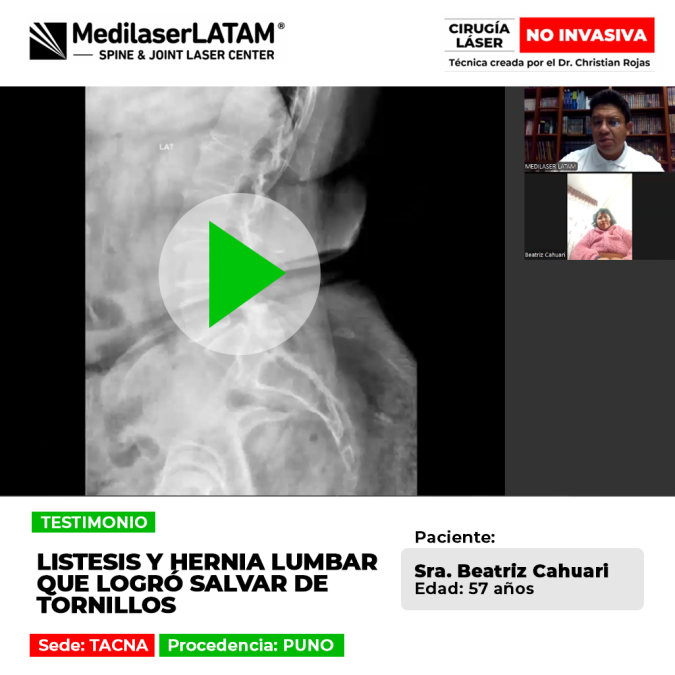 Conoce la historia de la paciente que logró evitar una cirugía compleja de fijación gracias a un tratamiento efectivo para la hernia lumbar.