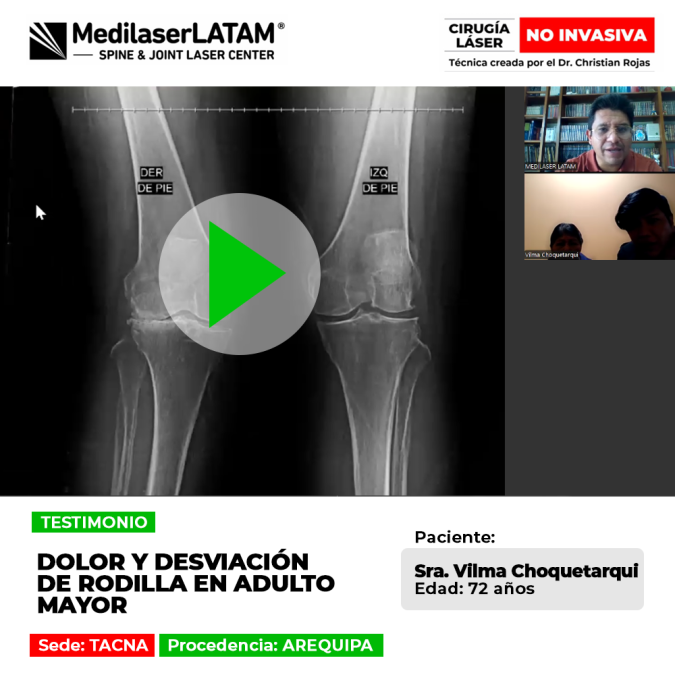Infórmate sobre el tratamiento alternativo que ayudó a corregir la desviación de rodilla y aliviar las molestias físicas crónicas.