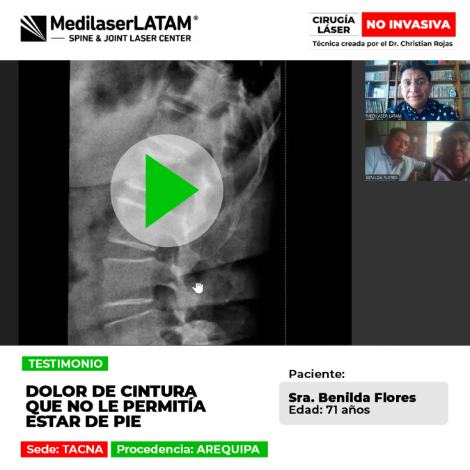 ¿Sufres de un dolor de cintura incapacitante? Descubre el tratamiento médico que ayudó a una paciente a recuperar su movilidad y bienestar.