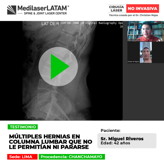 Las hernias columna lumbar severas pueden impedir ponerse de pie. Infórmate sobre procedimientos para superar la dolencia.