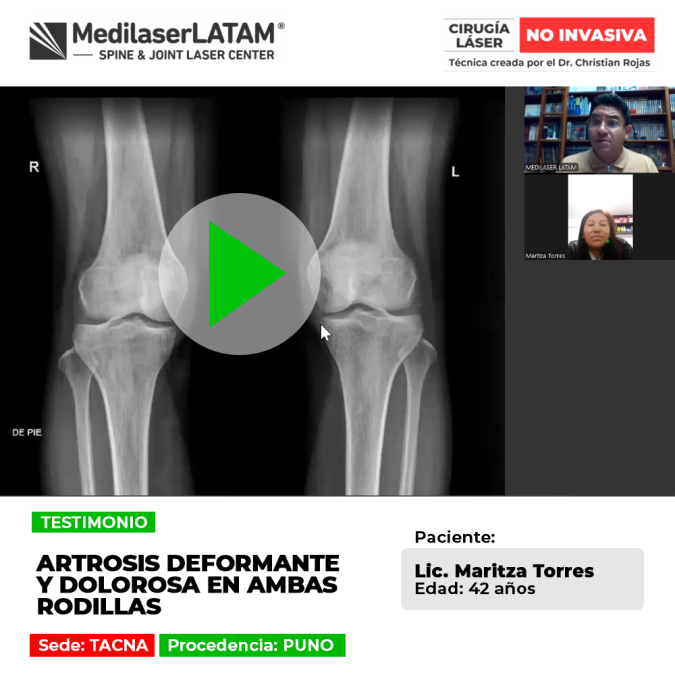 Artrosis deformante en rodillas: aprende sobre sus efectos en la articulación y los tratamientos para controlar el dolor.