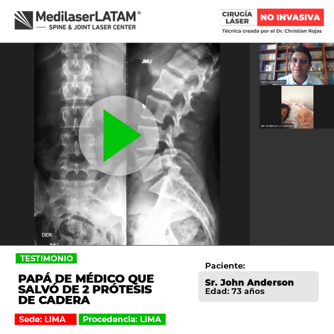 La prótesis de cadera puede evitarse mediante tratamientos oportunos. Conoce este caso médico de éxito y recuperación articular.