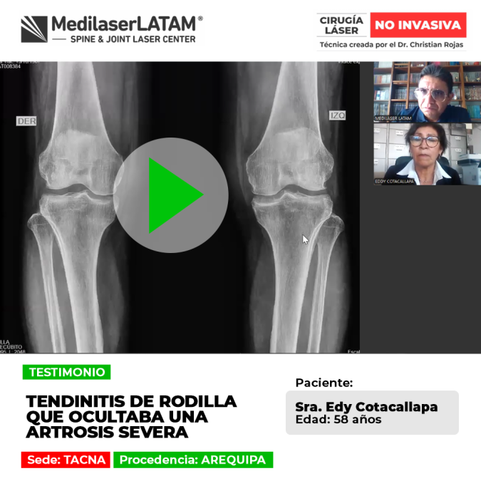 La artrosis severa rodilla puede confundirse con lesiones leves. Conoce la importancia de un diagnóstico médico certero y oportuno.