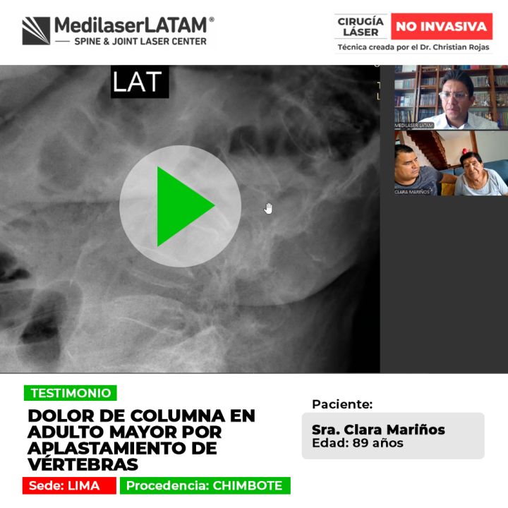 El aplastamiento de vértebras genera dolor agudo en la columna del adulto mayor. Conoce procedimientos médicos para su alivio.