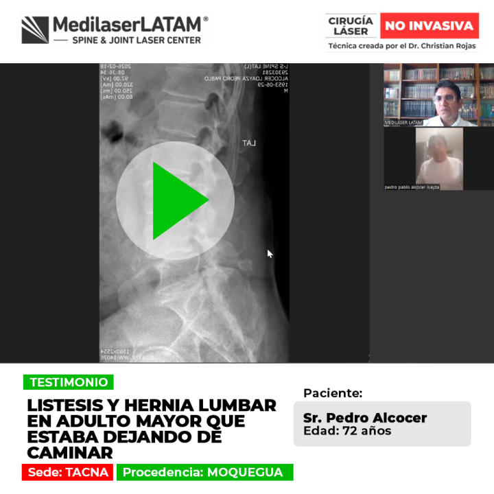 La listesis lumbar y las hernias pueden reducir la marcha en adultos mayores. Conoce alternativas efectivas para recuperar el andar.