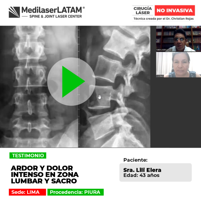 El dolor en zona lumbar y sacro suele vincularse a compromiso nervioso. Infórmate sobre tratamientos oportunos para su control.