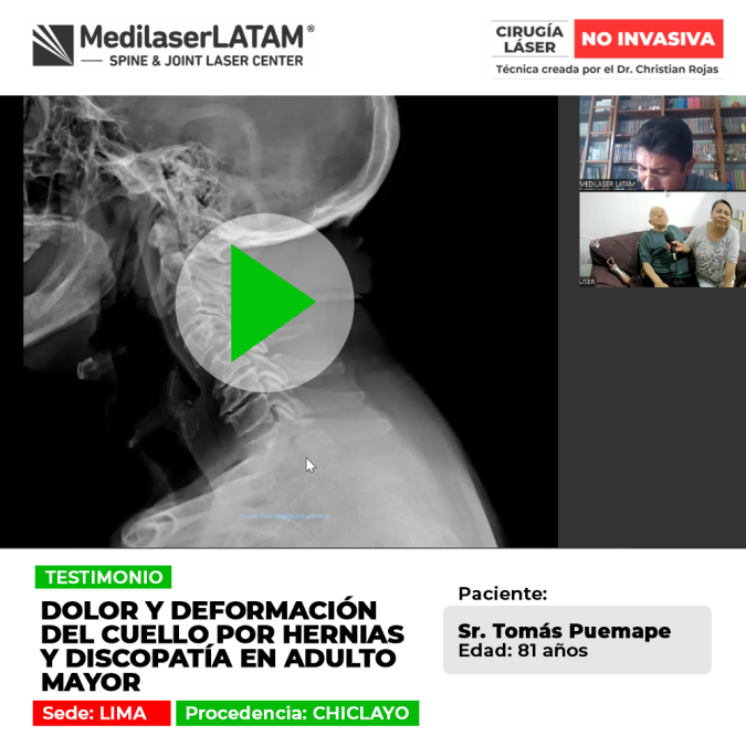Las hernias y discopatía en la zona cervical generan dolor y rigidez en adultos mayores. Conoce opciones médicas para su recuperación.