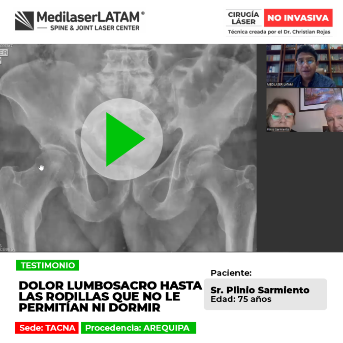 El dolor lumbosacro irradiado a las piernas perjudica el descanso nocturno. Conoce cómo tratar esta molestia y volver a dormir bien.