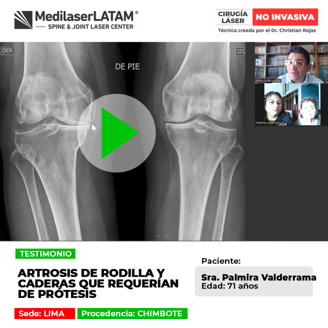 La artrosis de rodilla y cadera avanzada puede tratarse sin prótesis. Descubre opciones médicas efectivas para salvar la articulación.
