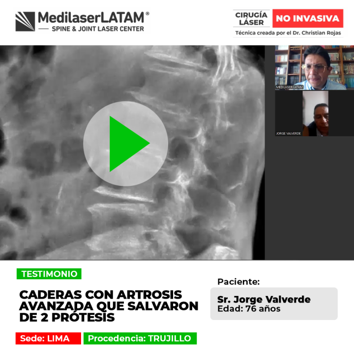 Las caderas con artrosis avanzada pueden recuperarse evitando prótesis. Conoce alternativas médicas seguras para volver a caminar bien.