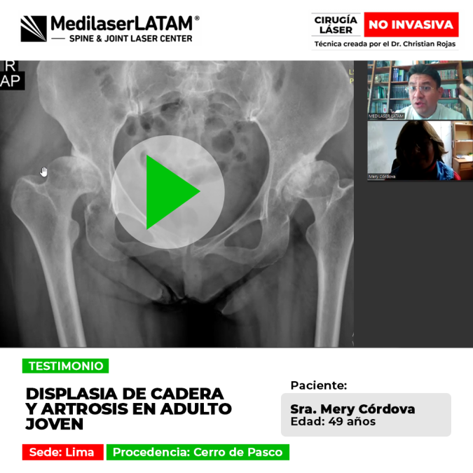 La displasia de cadera en adultos jóvenes puede provocar artrosis prematura. Infórmate sobre alternativas médicas para protegerla.