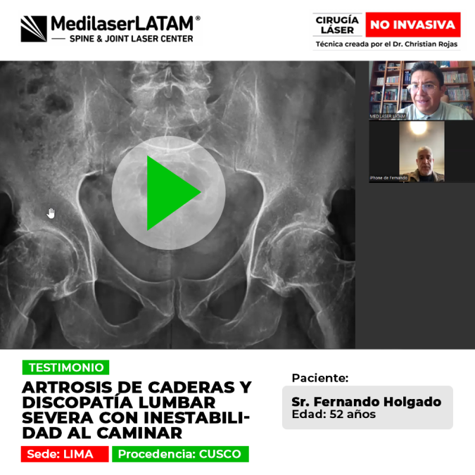 La artrosis de caderas y la discopatía lumbar producen inestabilidad severa al andar. Conoce cómo recuperar la firmeza al caminar.