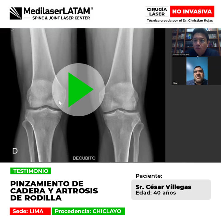 El pinzamiento de cadera y el desgaste articular en la rodilla limitan la movilidad. Descubre alternativas médicas para superarlo.