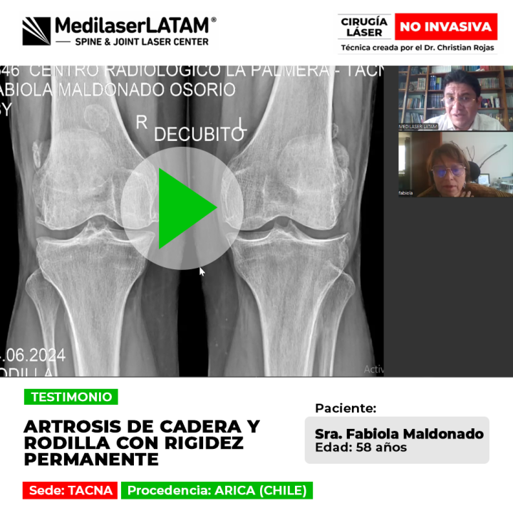 La artrosis de cadera y rodilla con rigidez continua dificulta los movimientos diarios. Descubre soluciones médicas para el alivio.