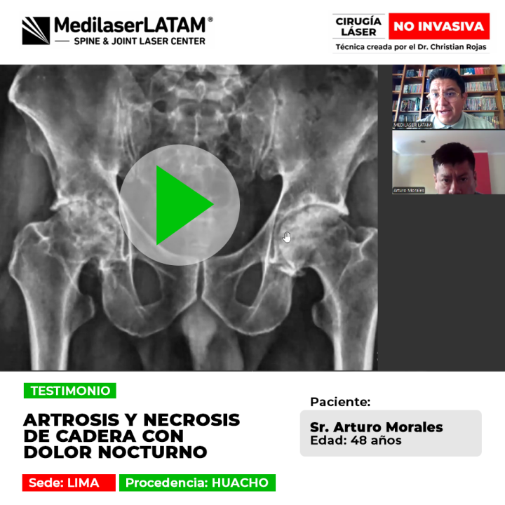 La necrosis de cadera y la artrosis causan dolores nocturnos intensos. Descubre alternativas médicas para proteger la articulación.