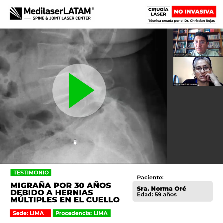 Las hernias múltiples cuello provocan migrañas crónicas de larga data. Infórmate sobre soluciones médicas para frenar este malestar.