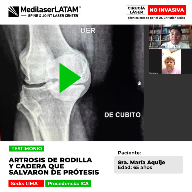 La artrosis de rodilla y cadera avanzada puede tratarse evitando prótesis. Infórmate sobre procedimientos médicos especializados.