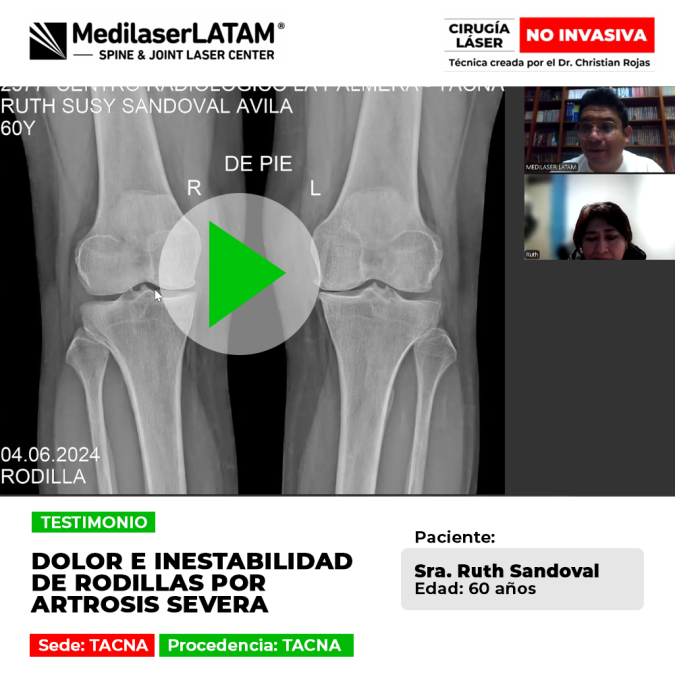 La artrosis severa rodillas causa dolor e inestabilidad al andar. Descubre procedimientos médicos seguros para frenar el desgaste.